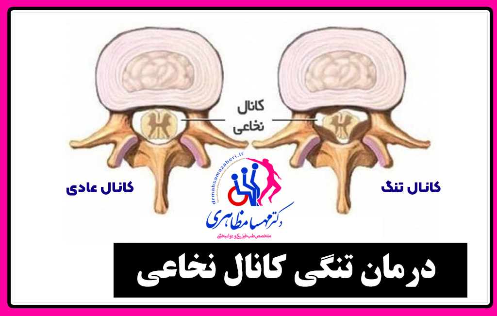 درمان تنگی کانال نخاعی در اصفهان